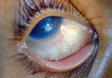 wrinkled cornea|cornea wrinkle surgery.